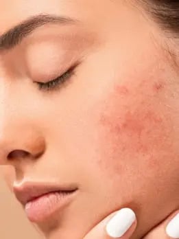 prevent-future-breakouts jpg