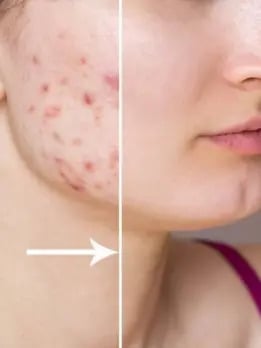reduce-acne-scars jpg